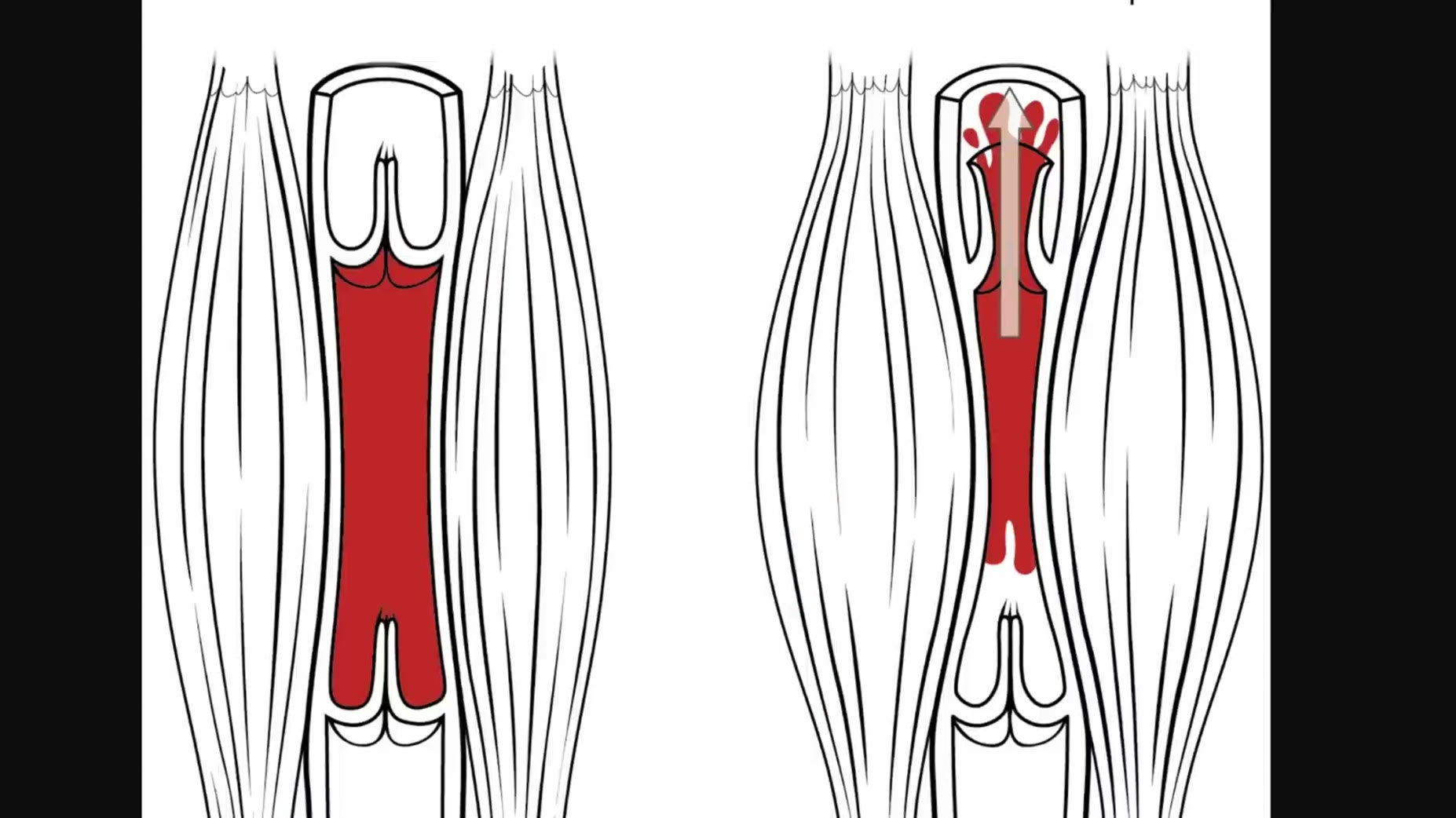 Calf muscles expand and squeeze the leg vein to mechanically force blood upward, with a one-way venous valve preventing 